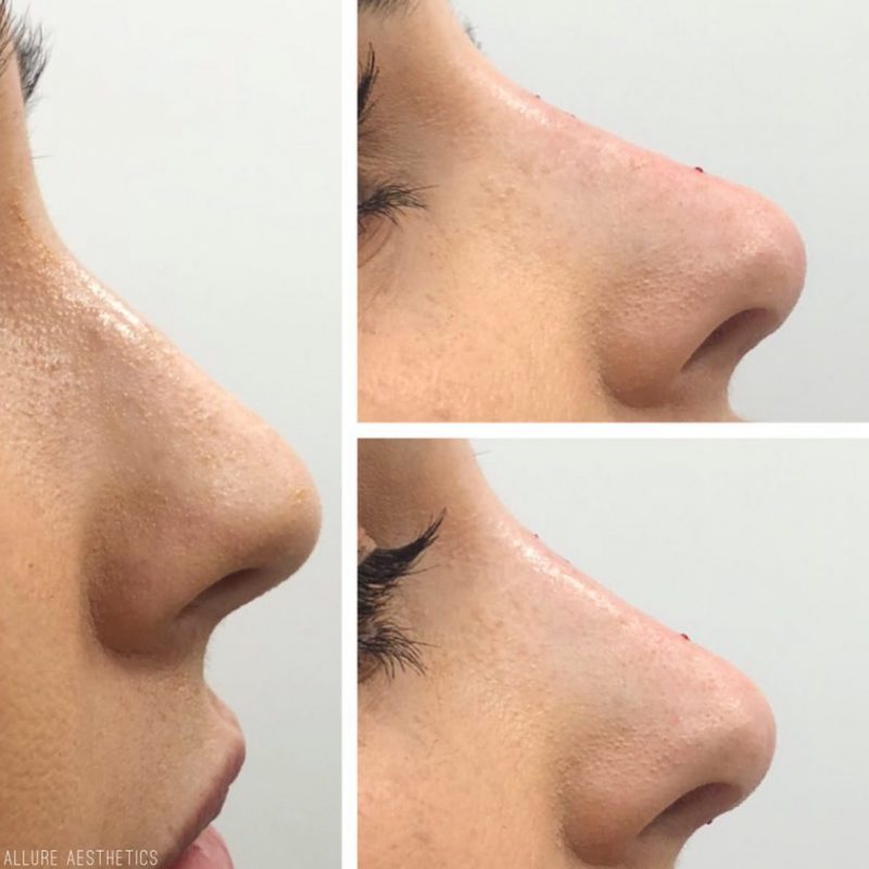 Nose Fillers AS Allure Aesthetics, Notting Hill / Kensington, London