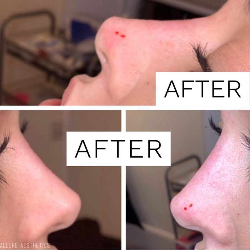 Nose Fillers AS Allure Aesthetics, Gloucester Rd / South Kensington