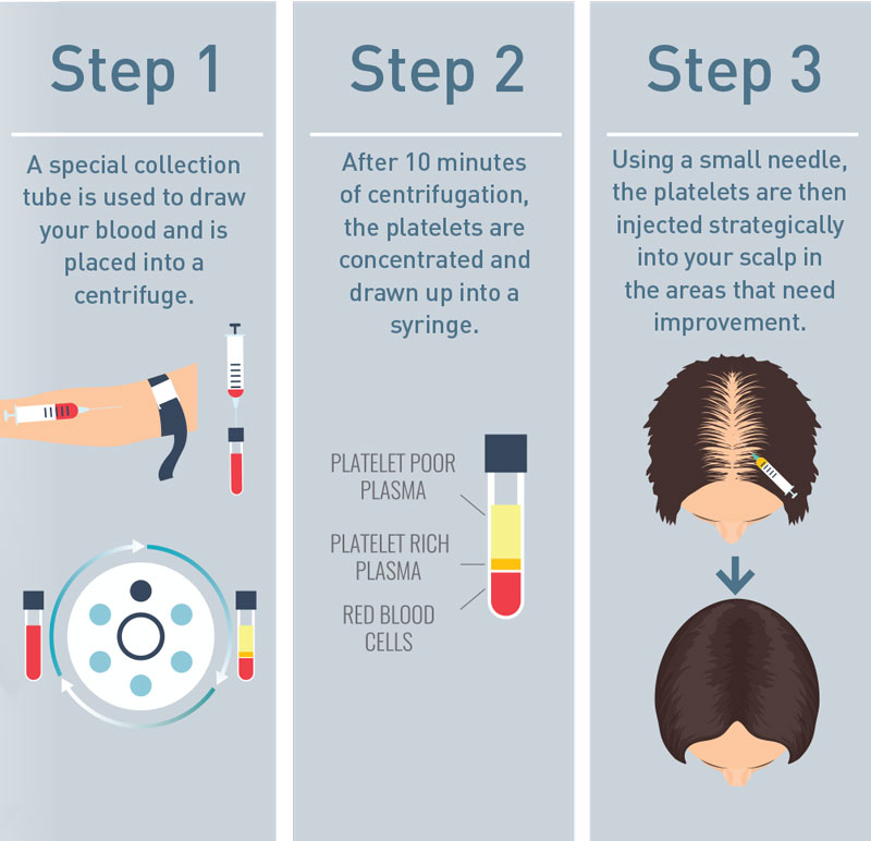 Dr Nama Plateletrich plasma (PRP) therapy AS Allure Aesthetics