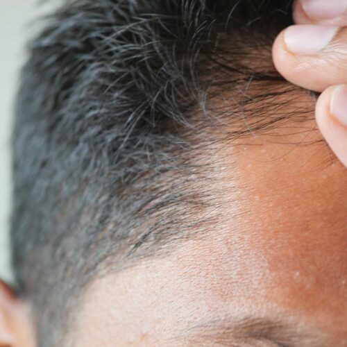Hair Loss in Men & Women